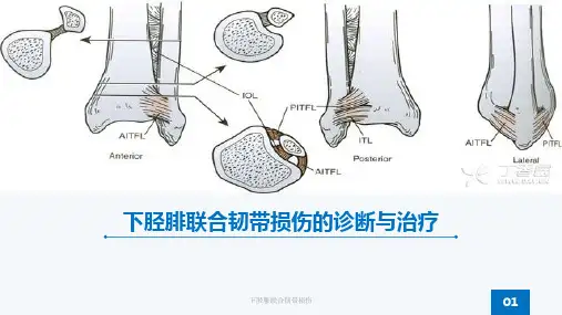下胫腓联合韧带损伤