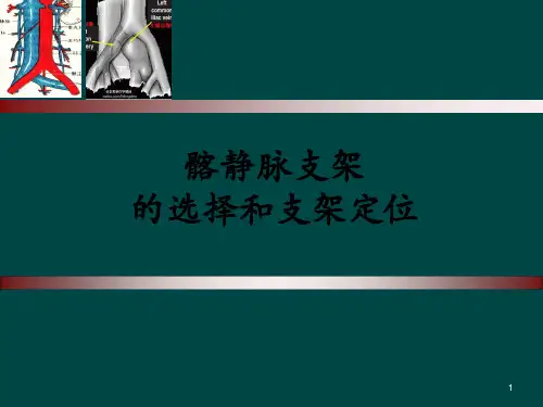 髂静脉支架的选择和支架定位ppt课件