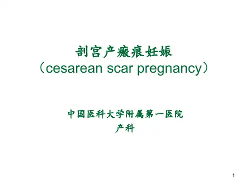 剖宫产瘢痕妊娠ppt课件