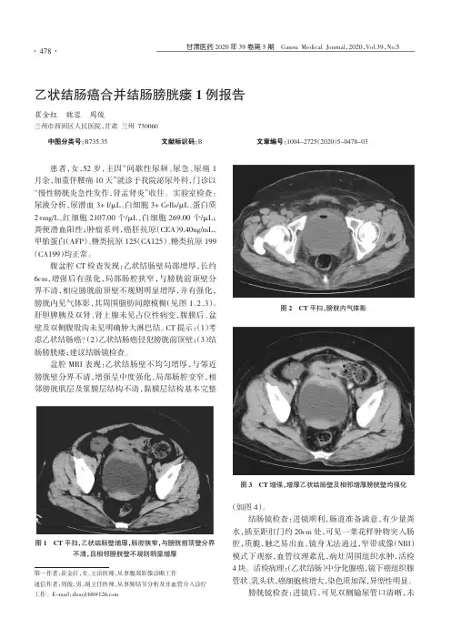乙状结肠癌合并结肠膀胱瘘1例报告
