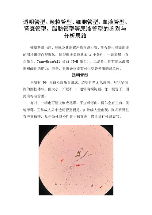 透明管型、颗粒管型、细胞管型、血液管型、肾衰管型、脂肪管型等尿液管型的鉴别与分析思路