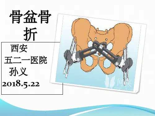 骨盆骨折分型、治疗及康复ppt课件