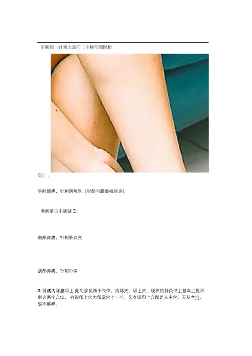 各种疼痛的针灸治疗穴位配图片超好用哦