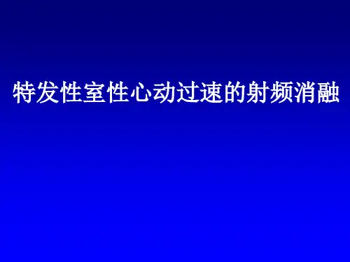 特发性室性心动过速的射频消融