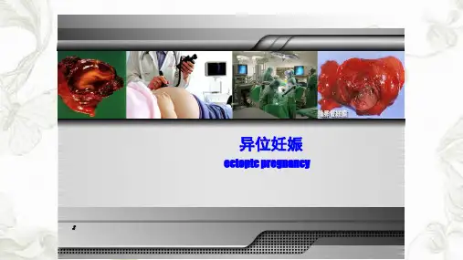 异位妊娠ppt课件