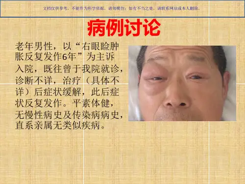 眼眶炎性假瘤课件
