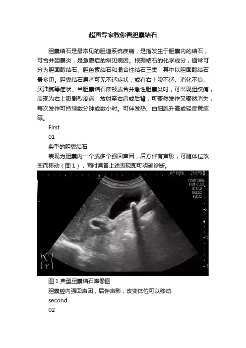 超声专家教你看胆囊结石