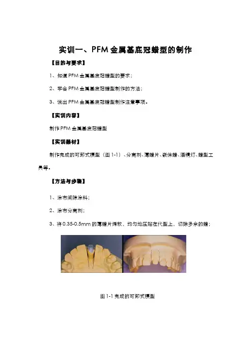 实训 PFM 金属基底冠蜡型的制作