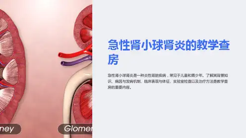 急性肾小球肾炎的教学查房