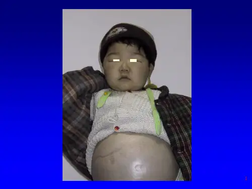 肾病综合征(1)ppt学习课件