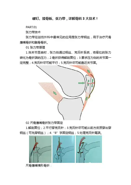 螺钉、接骨板、张力带，详解骨科3大技术！