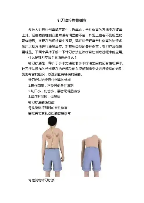 针刀治疗脊椎侧弯