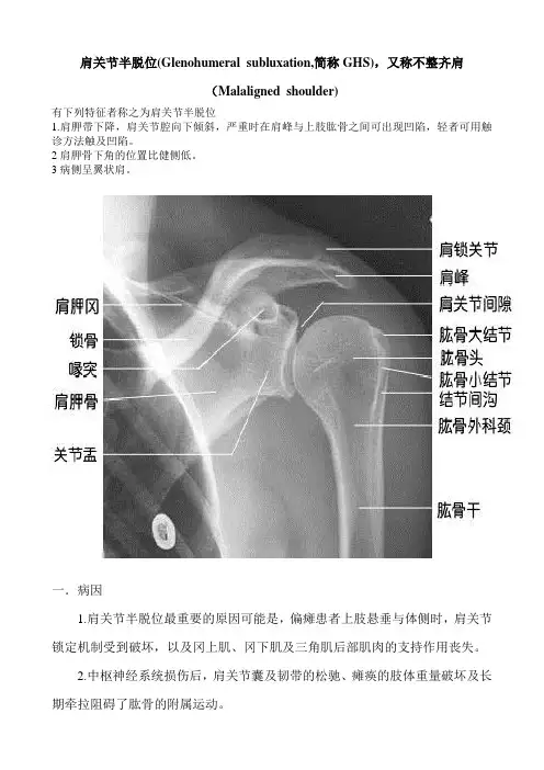 肩关节半脱位(Glenohumeral subluxation,简称GHS),又称不 …