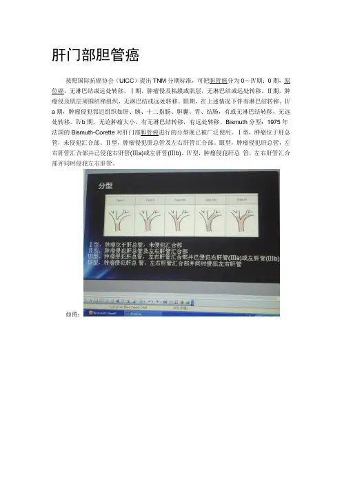 肝门部胆管癌分型