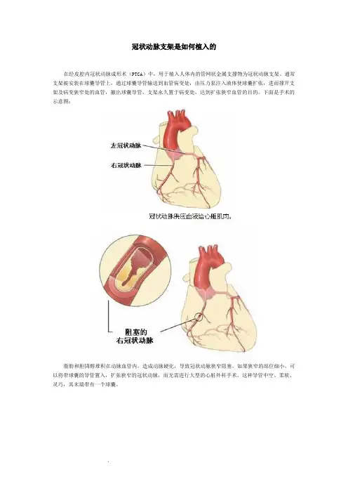 冠状动脉支架是如何植入的
