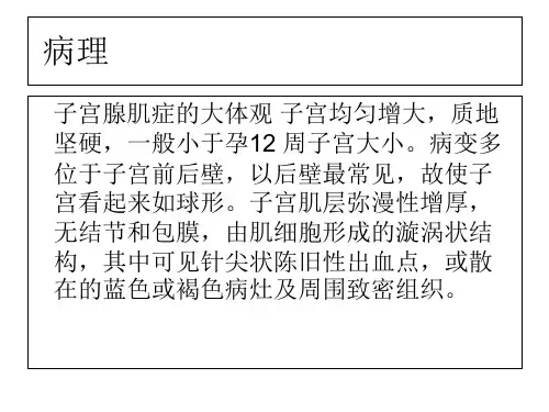 子宫腺肌课件-PPT文档资料