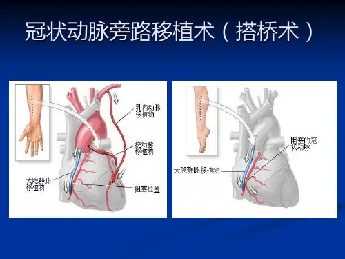 冠心病外科治疗心血管外科ppt课件