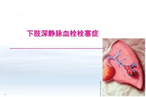 静脉血栓栓塞症ppt课件