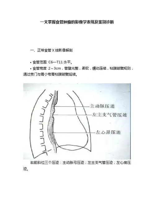 一文掌握食管肿瘤的影像学表现及鉴别诊断