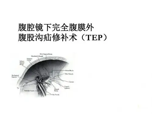 腹腔镜下完全腹膜外腹股沟疝修补术(TEP)