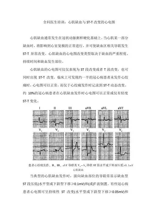 全科医生培训：心肌缺血与ST-T改变的心电图