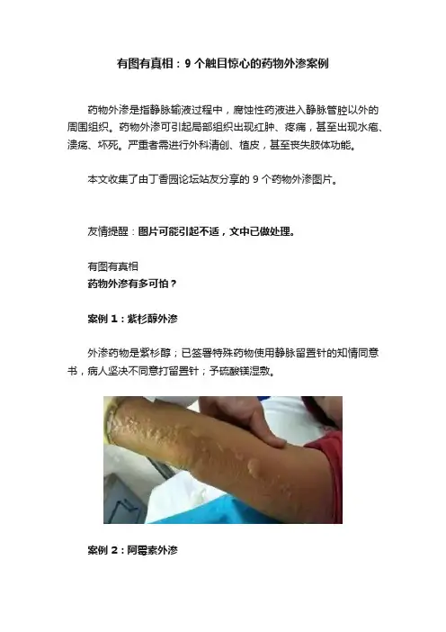 有图有真相：9个触目惊心的药物外渗案例