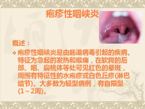 疱疹性咽峡炎PPT课件