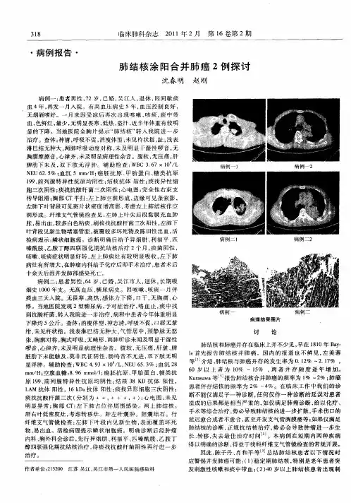 肺结核涂阳合并肺癌2例探讨