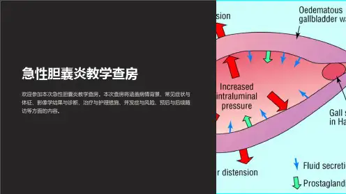 急性胆囊炎教学查房
