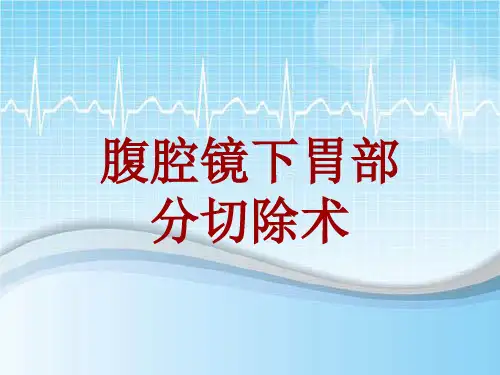 手术讲解模板：腹腔镜下胃部分切除术