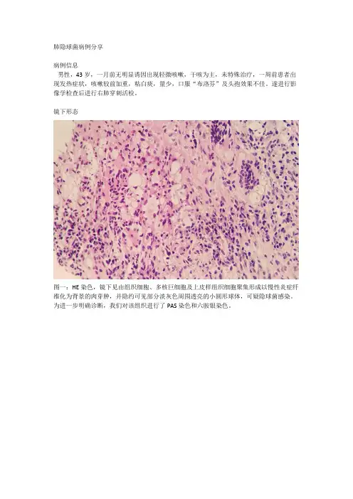 一例肺部隐球菌感染的病例分享
