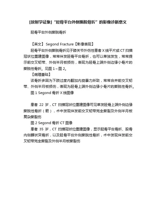 [放射学征象]“胫骨平台外侧撕脱骨折”的影像诊断意义