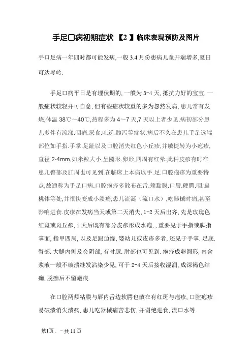 手足口病初期症状及图片-手足口病症状图片