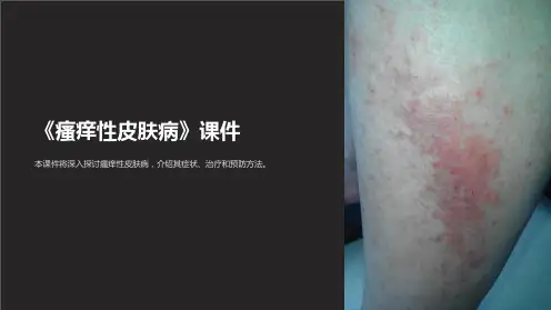 《瘙痒性皮肤病》课件