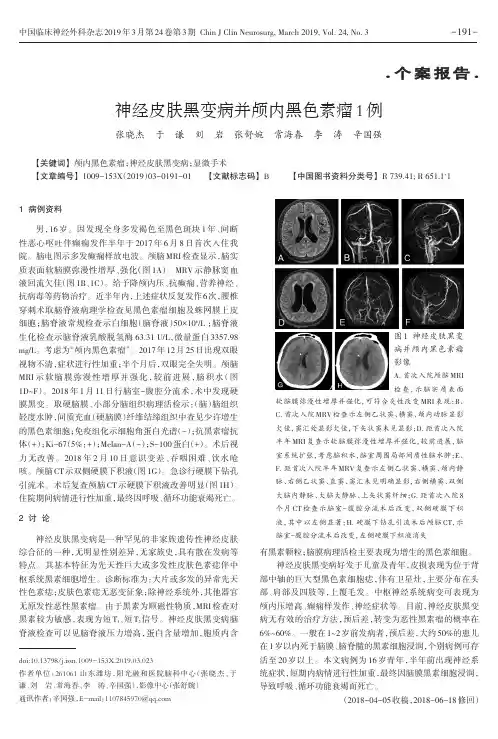 神经皮肤黑变病并颅内黑色素瘤1例