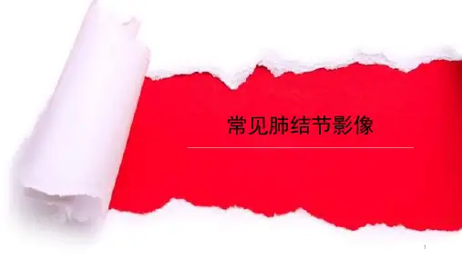 常见肺结节影像PPT课件