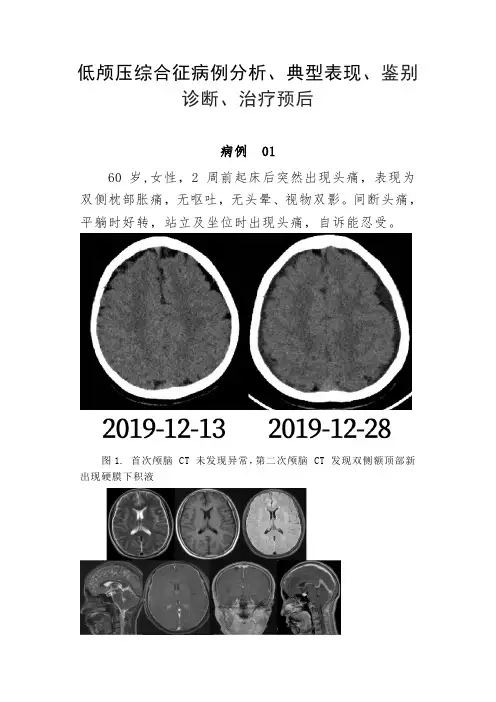 低颅压综合征病例分析、典型表现、鉴别诊断、治疗预后