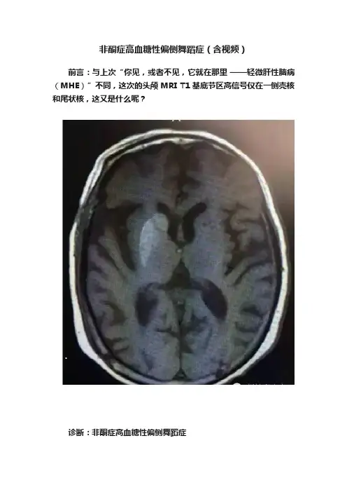 非酮症高血糖性偏侧舞蹈症（含视频）