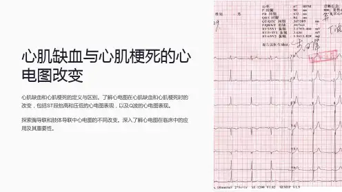 心肌缺血与心肌梗死的心电图改变