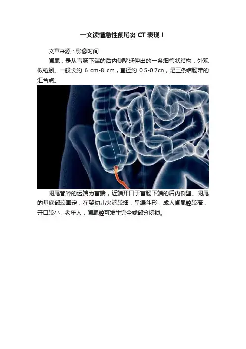 一文读懂急性阑尾炎CT表现！