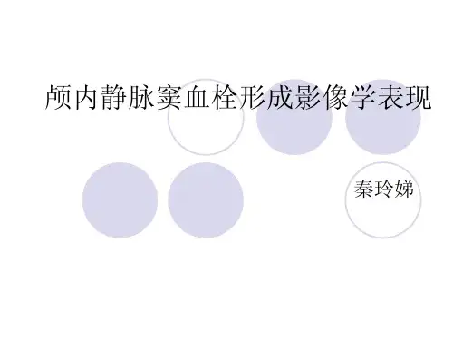 颅内静脉窦血栓形成影像学表现