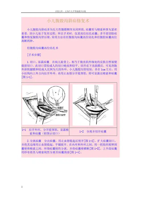 2小儿腹股沟斜疝修复术图