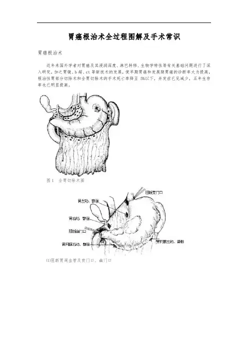 胃癌根治术全过程图解及手术常识1