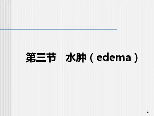 诊断学  水肿PPT课件