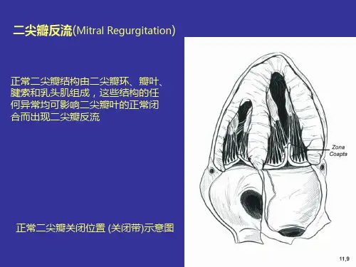 心脏超声课件：二尖瓣反流