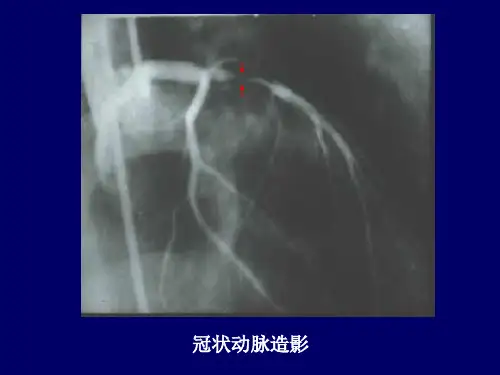 第五节冠心病病理学PPT课件