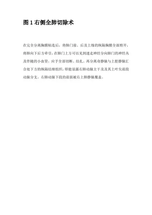 浅谈各部位肺切除术