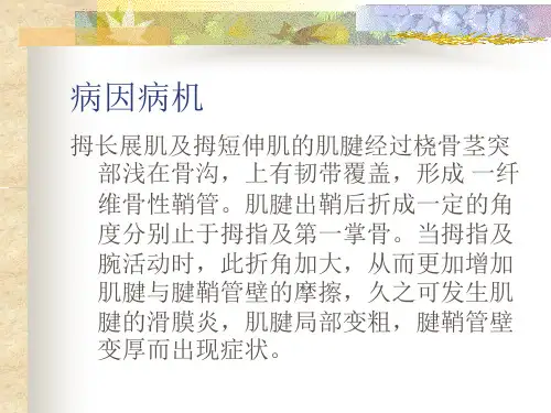 桡骨茎突狭窄性腱鞘炎