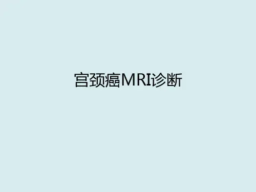 宫颈癌的影像表现