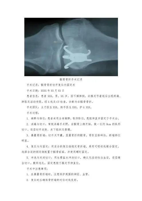 髌骨骨折手术记录